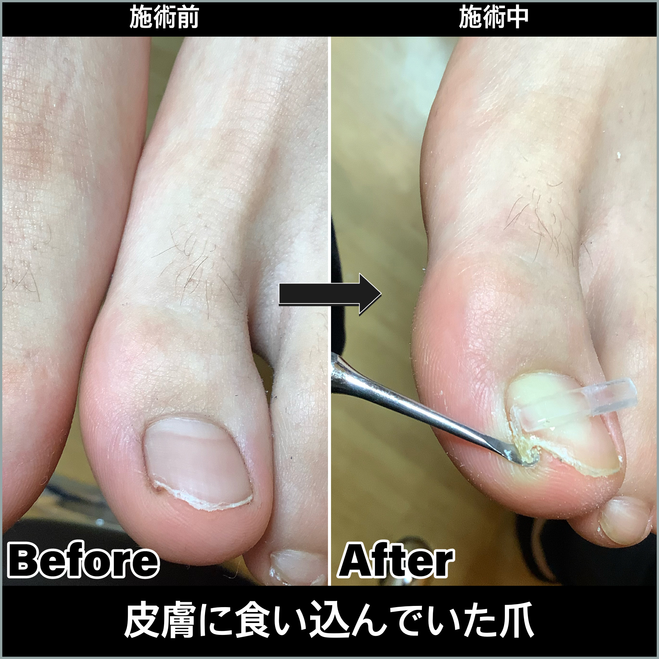 ちょっと深爪かな？