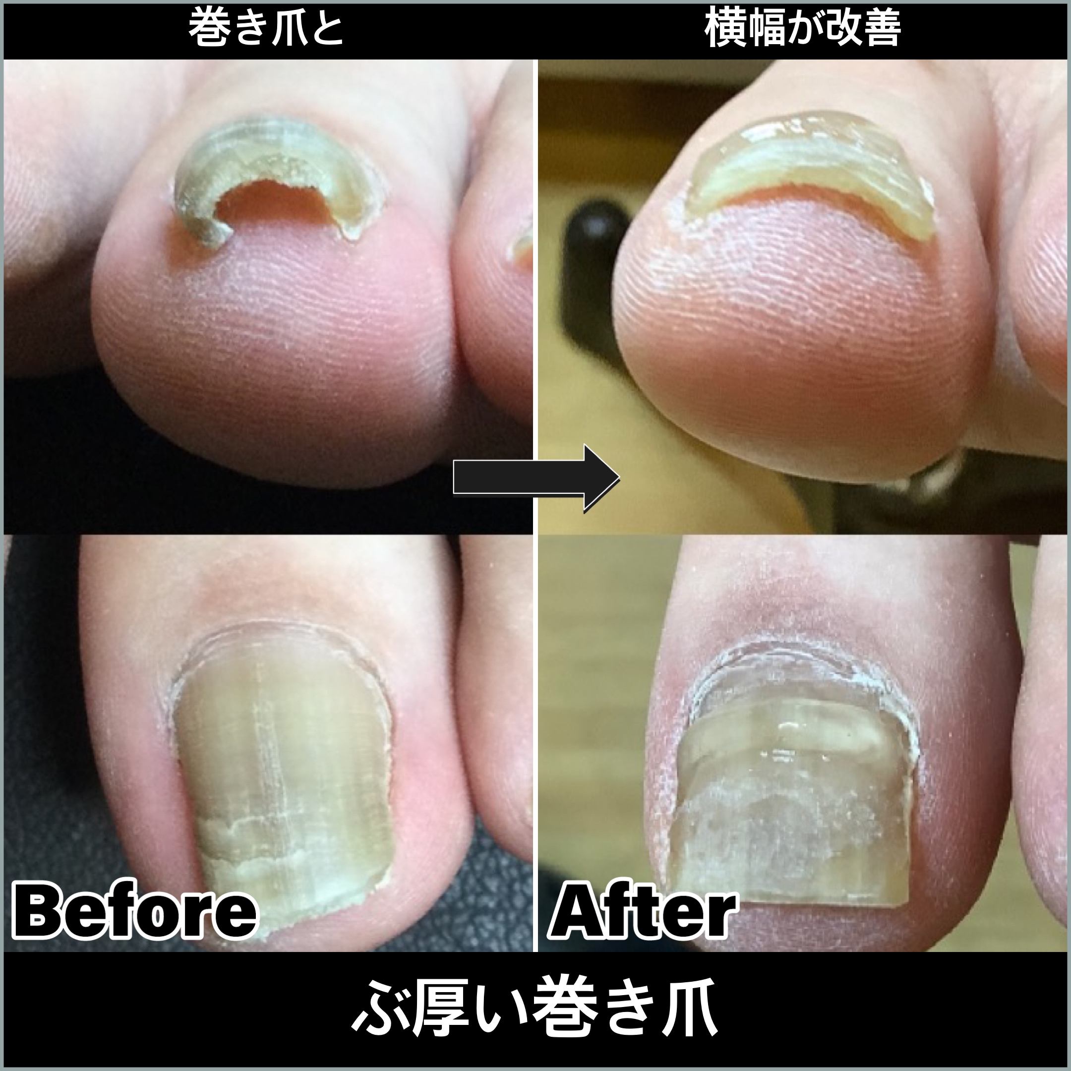 分厚い爪でも
