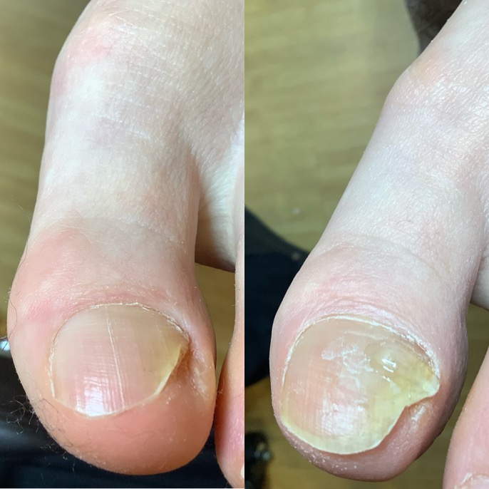 痛むから爪をどんどん切って