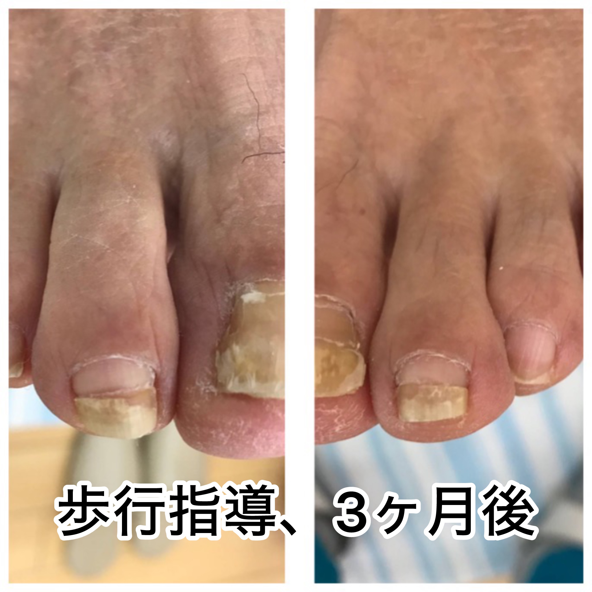 70代の厚くなった爪でも努力すれば